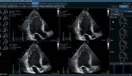 Vivid E95 and E90: AFI Stress Analysis