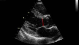 Vivid 4 / 3: Calculation of the aortic valve area with continuity ...