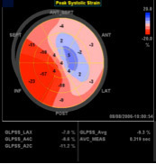 Vivid E9 /S6: AFI - Automated Functional Imaging