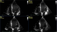 Vivid 4 / 3: Optimize your Stress Echo