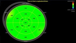 Vivid E95 / E90 / S70: AFI and cardiac dyssynchrony