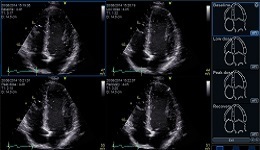 Vivid E95 / E90: Stress Echo with integrated AFI workflow