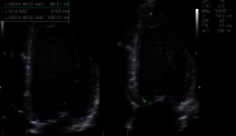 Vivid 3: How to Calculate Ejection Fraction 