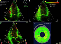 TSI - Tissue Synchronisation Imaging for detecting Async ...