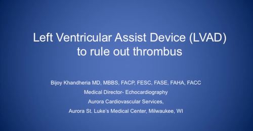 CVUS Tech Expo: LVAD to Rule Out Thrombus with Dr. Bijoy ...