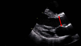 Vivid E9 / S6 / S5: Continuity equation for aortic valve ...