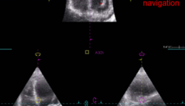 Working with the TomTec 4D RV Volume Plug in for EchoPAC ...