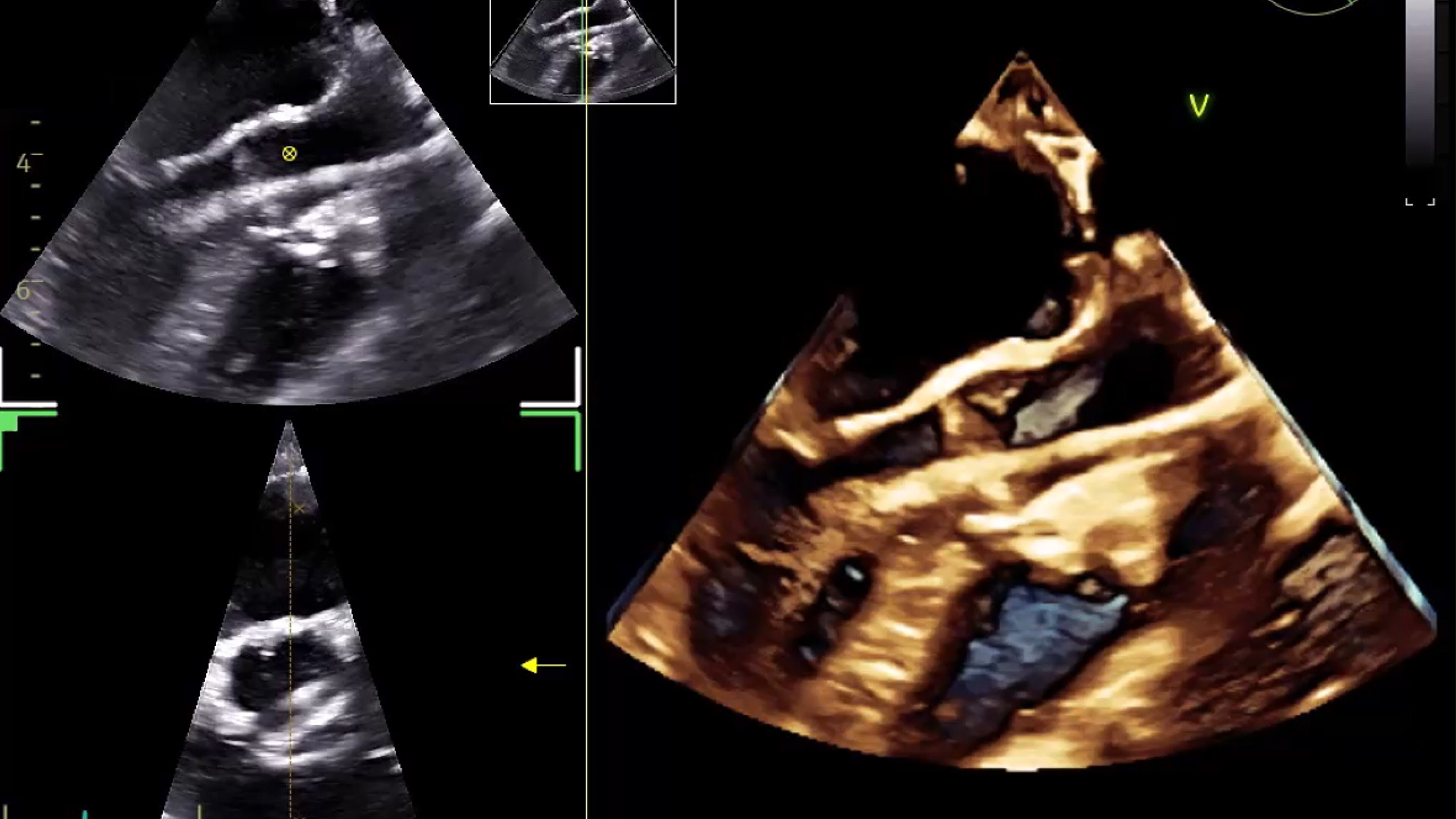 Valvuloplasty in pediatric patient with 9VT-D, 3D TEE mini probe