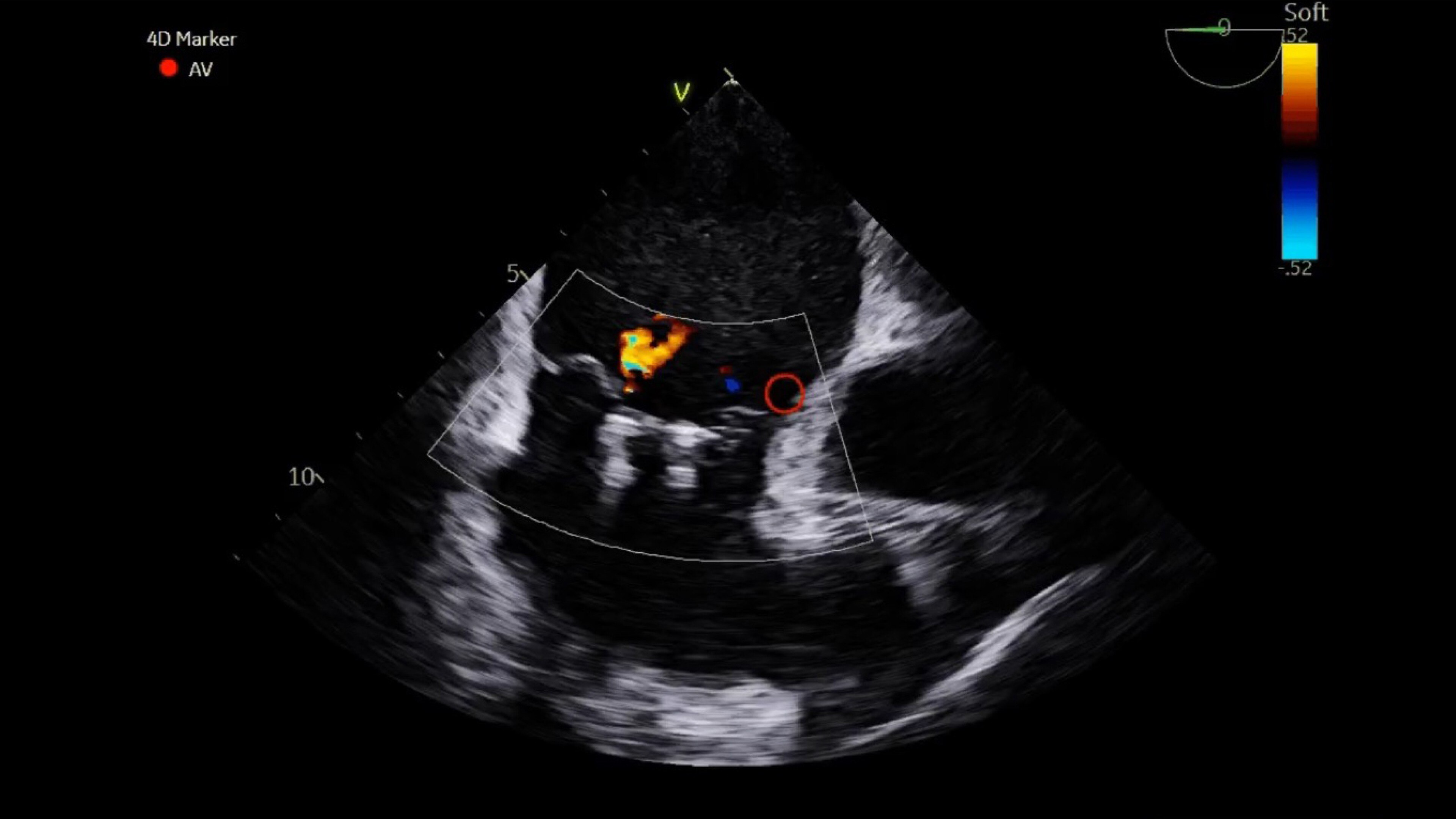 4D ICE NUVISION ultrasound catheter