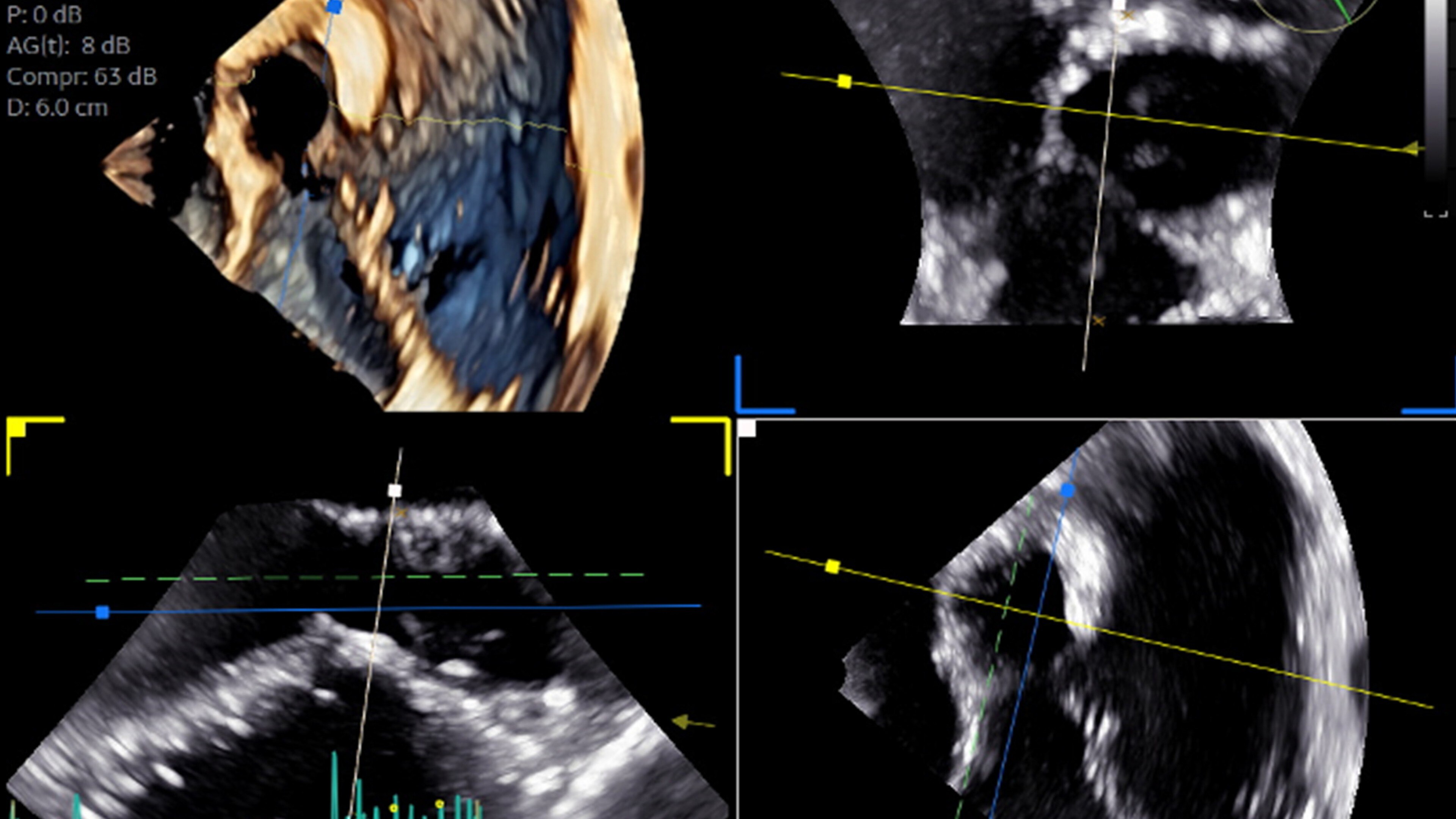 9VT-D mini 3D TEE probe guiding personalized subaortic and aortic valve surgery