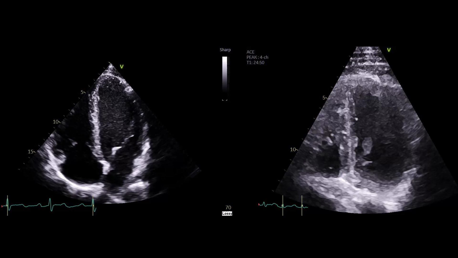 Athlete’s heart or dilated cardiomyopathy?