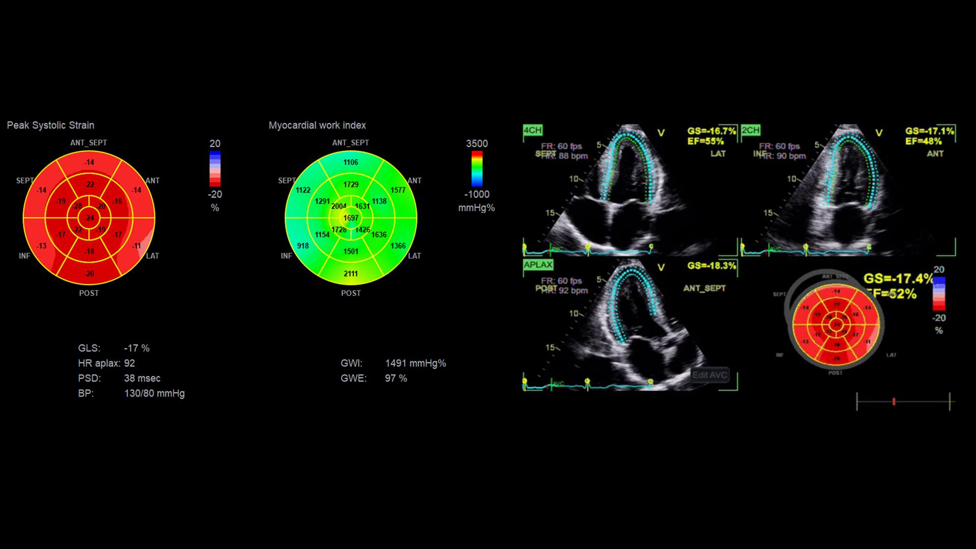 Detecting myocardial dysfunction in steroid users