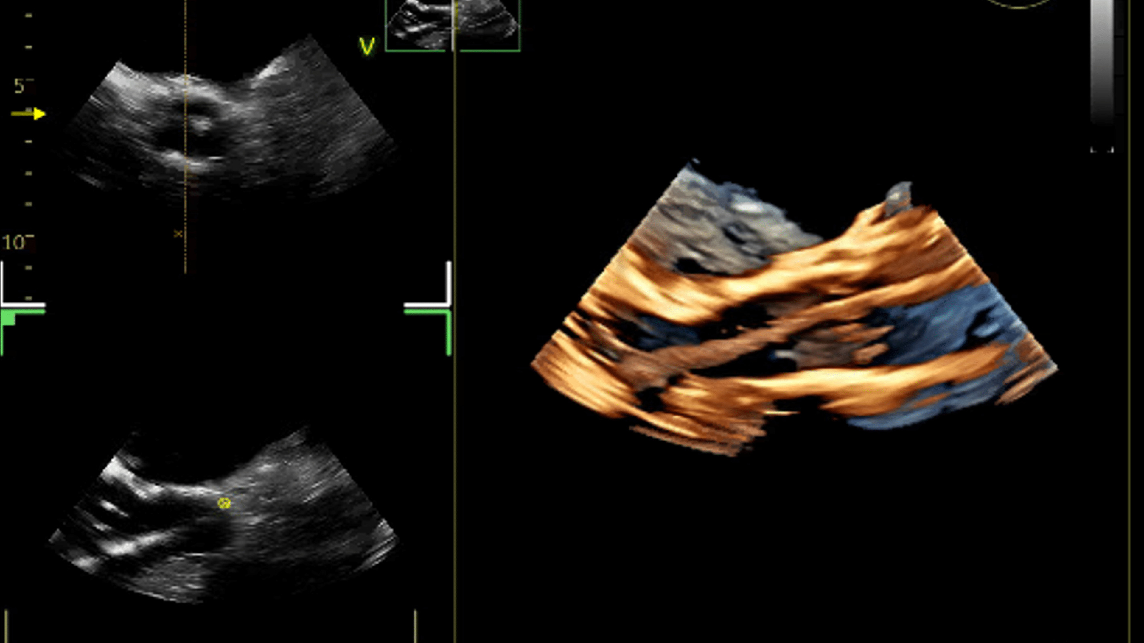 9VT-D mini 3D TEE brings imaging option to patient getting a TAVR from transcarotid approach