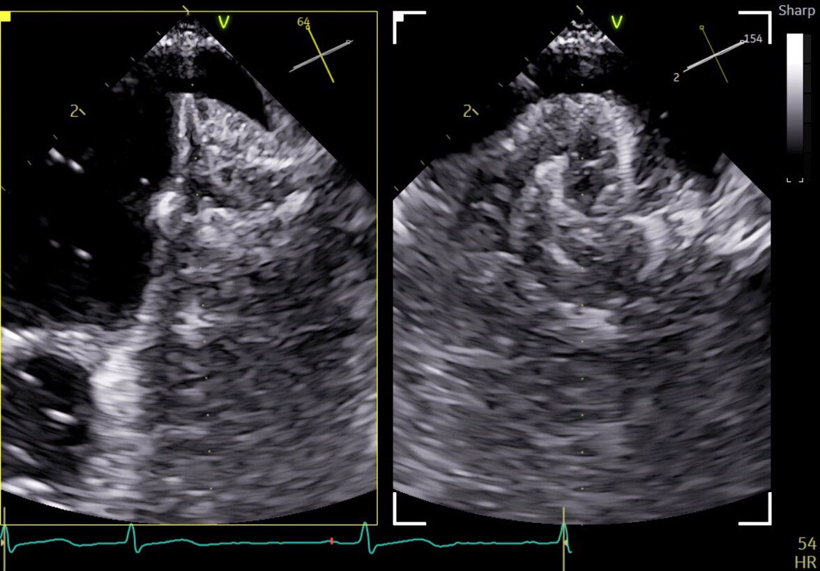 Left Atrial Appendage Closure with 9VT-D